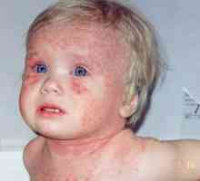 Vyrážka u dětí v dysbacteriosis