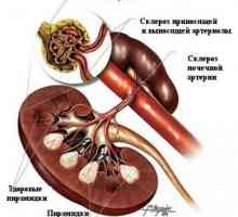 Ke konečné fázi nemoci ledvin (chronické selhání ledvin), diabetes