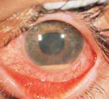 Toxoplazmóza retinohorioidit