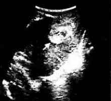 Transvaginální ultrazvuk diagnóza poporodní endometritidy