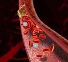 Mezenterických žilní trombóza