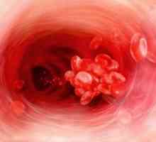 Portál žilní trombóza, příznaky, léčba, příčiny
