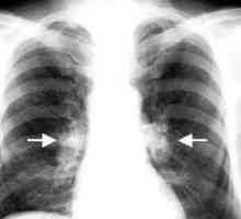 Tuberkulóza nitrohrudních mízních uzlin: léčbu, komplikace, příčiny, příznaky