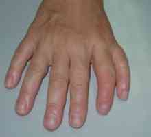 Zdvojnásobení prvního prstu (nebo nosníku preaxial polydaktylie)