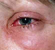 Modřiny a zraněných očí: léčba, první pomoc, příčiny, příznaky, znaky