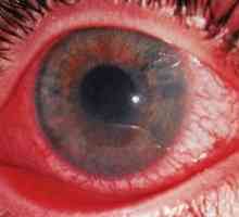 Uveitida oko: léčba, příznaky, příčiny, příznaky, diagnóza