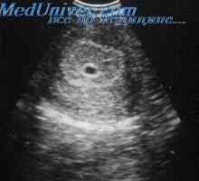 Ultrazvuk v prvním trimestru těhotenství. Indikace pro TVU v prvním trimestru těhotenství