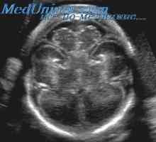 Prenatální péče s ventrikulomegalie. vrozený hydrocefalus