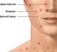 Plané neštovice: léčba, příznaky, prevence, příznaky, příčiny