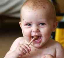 Plané neštovice u dětí, léčba, symptomy, příčiny, příznaky