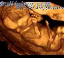 Vrozená amputace plodu. Syndrom aglossia-adactylia