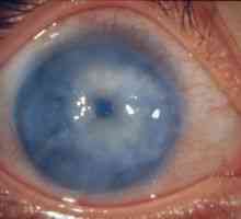 Sekundární glaukom oka: léčba, příčiny, klasifikace, symptomy, znaky