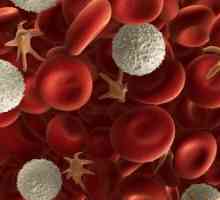 Sekundární hemochromatóza: Příznaky