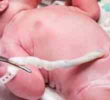 Výhřezu pupečníku při porodu: vlivy, příčiny