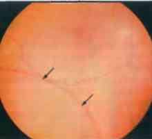 Nemoci obvodu sítnice: degenerativní retinoschisis
