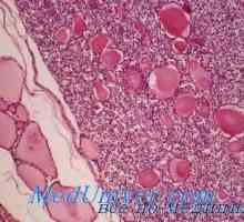 Zhoubné nádory příznaků štítné žlázy, klasifikace
