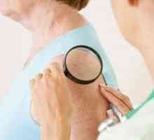 Zhoubné kožní nádory: Klasifikace