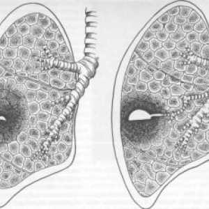 Plicní absces: příznaky, léčba, diagnóza, komplikace, příčiny, příznaky