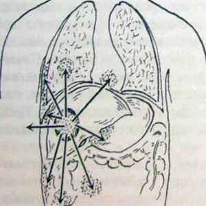 Jaterní abscesy. klinický obraz