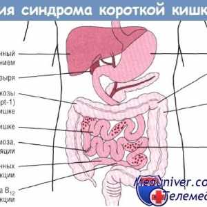 Vliv syndromu krátkého střeva (SPV) na gastrointestinální trakt