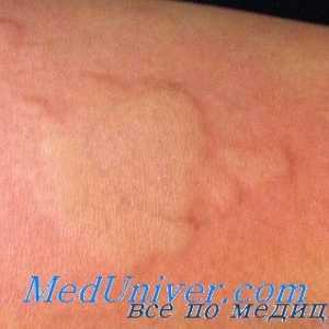 Adrenostimulyatorov alergie. Anticholinergika s alergickými reakcemi
