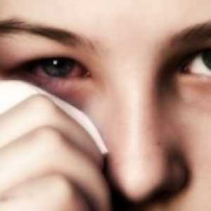 Alergický zánět spojivek: léčba, příznaky, příčiny, příznaky