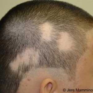 Alopecia areata: Léčba