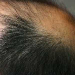 Alopecie Vlasy: Prostředky pro léčbu, příčiny, příznaky, příznaky
