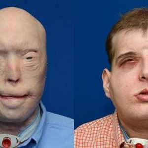 Američtí chirurgové transplantovány obličej spálený hasič