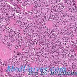 Rakovina štítné žlázy amyloid. Scirrhous rakoviny štítné žlázy