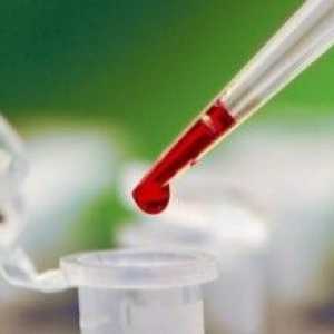 Analýza krve rakoviny slinivky