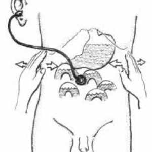Ovariotomy