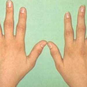 Artritida metacarpal falanga kloub ruky: léčba, příznaky, znaky, příčiny