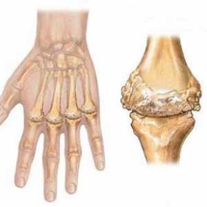 Zánětlivé artritidy (infekční a infekční-alergické)