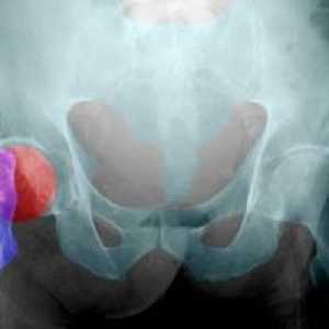 Aseptická nekróza kosti: stupeň ošetření, příčiny, příznaky, znaky