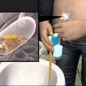 Aspireassist: chirurgický implantát k léčbě obezity