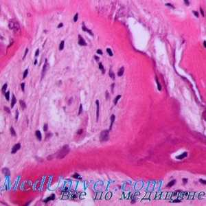 Ateroskleróza v pozadí inzulínové rezistence. Tuku metabolismus u diabetu a pre-diabetické stavu