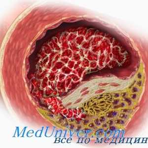 Ateroskleróza v menopauze a menopauza. Vliv testosteronu na arteriosklerózu androgenů