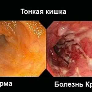 Crohnova choroba a ulcerózní kolitida