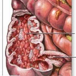 Toto onemocnění tenkého střeva Crohnova