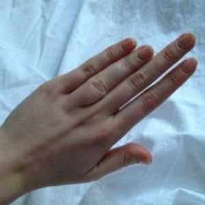 Brachydaktylie palec: příčiny, léčba, příznaky, příznaky