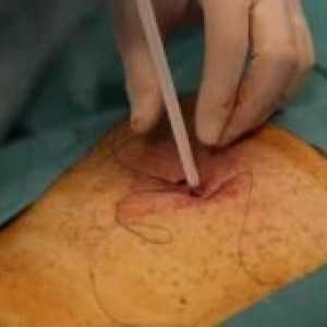 Perkutánní endoskopická gastrostomie