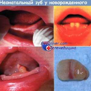 Neonatální zub novorozené příčiny, diagnostika