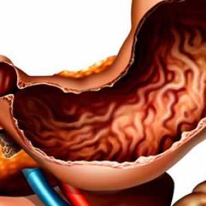 Co je chronický zánět žaludku anatsidny, její příznaky a léčba