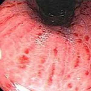 Co je to povrchní gastroduodenitis: symptomy, příčiny a léčba