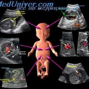 Barevný Doppler sonografie se molární těhotenství. Plavidla mapování barva plodů