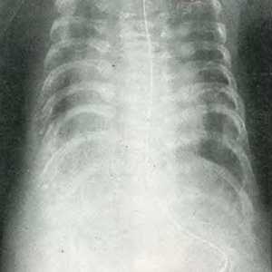Deformace hrudníku v difúzních kosterních poruch
