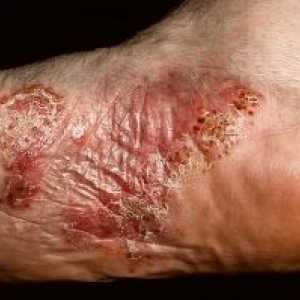 Dermatitida rukou a nohou