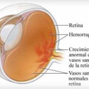 Neproliferativní diabetická retinopatie a diabetická retinopatie (NPDR)