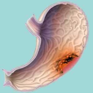 Difusní rakoviny žaludku